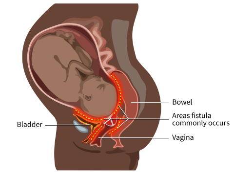 obstetrical