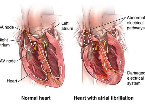 fibrillate