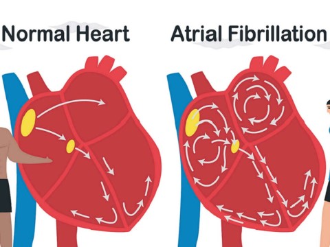 fibrillation