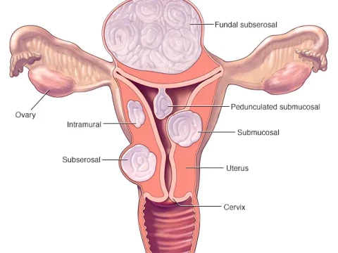 fibroid