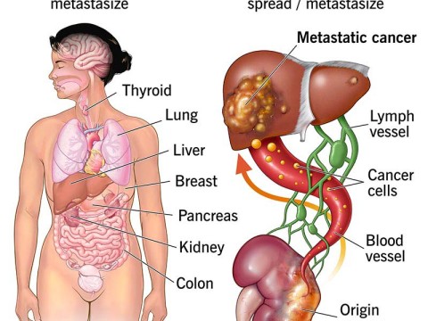 metastasize