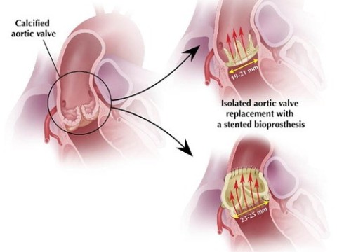 homograft