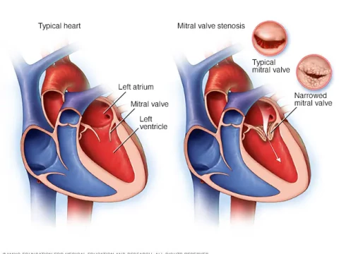 mitral