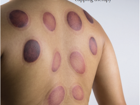 cupping