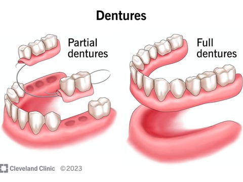 denture